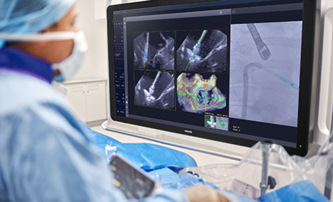Premiere: Philips bringt KI in den Operationssaal, um &Auml;rzte bei der Rekonstruktion undichter Herzklappen zu unterst&uuml;tzen